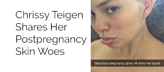 Chrissy Teigen Shares Her Postpregnancy Skin Woes